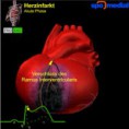 /album/fotogaleria-novedades/infarto-corazon-jpg/